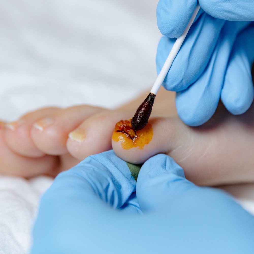 Curación de úlceras y heridas Curación de úlceras y heridas